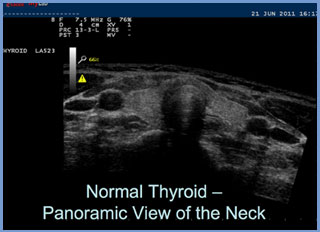 Normal Thyroid image