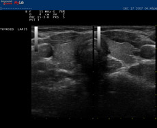 Normal Thyroid image